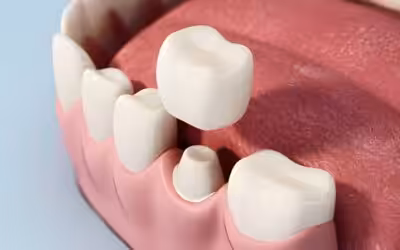 How Long Does a Dental Crown Last?
