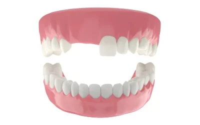 What Happens If You Ignore a Missing Tooth?